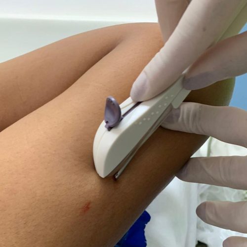 Implanon passa a ser ofertado no SUS e Itabela inicia processo de implantação do método contraceptivo